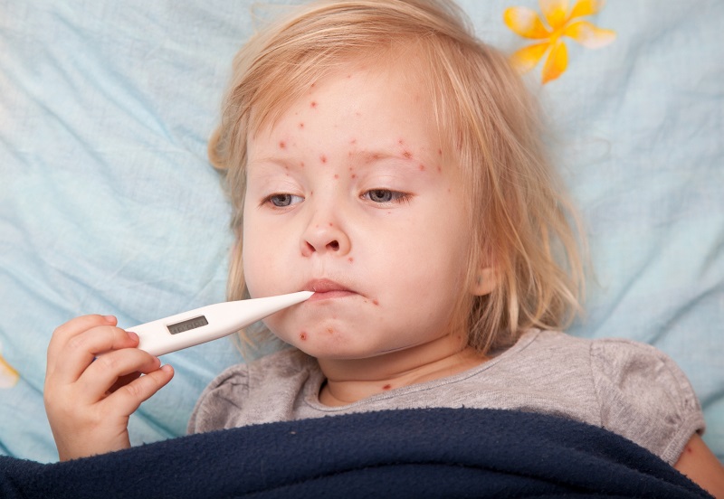 Hướng dẫn chăm sóc trẻ bị bệnh thủy đậu để tránh biến chứng nguy hiểm